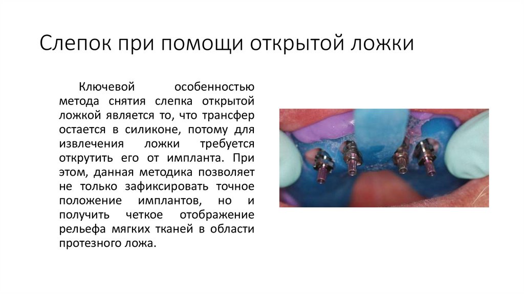 Слепок при помощи открытой ложки