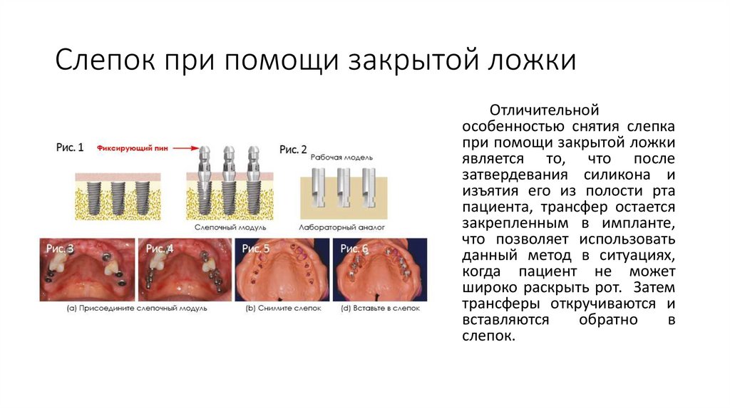 Слепок при помощи закрытой ложки