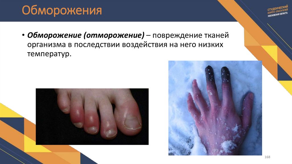 Обморожения