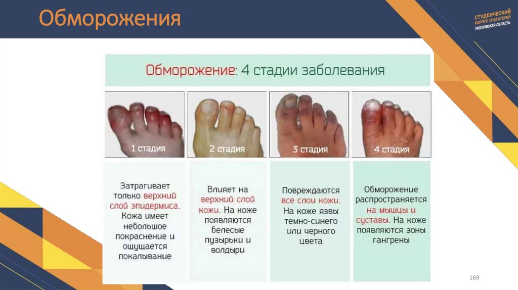 Обморожения