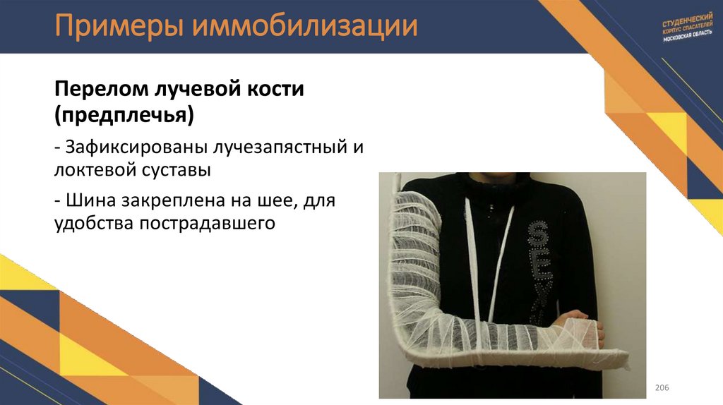 Примеры иммобилизации