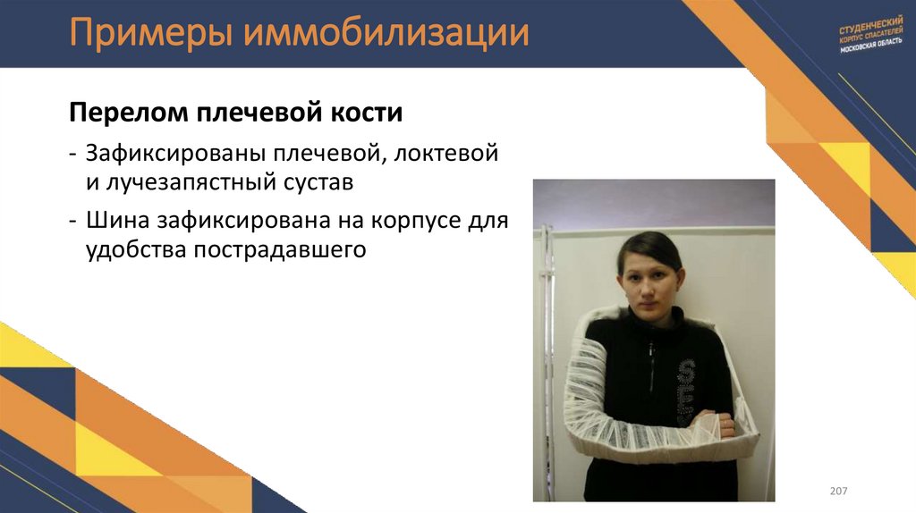 Примеры иммобилизации