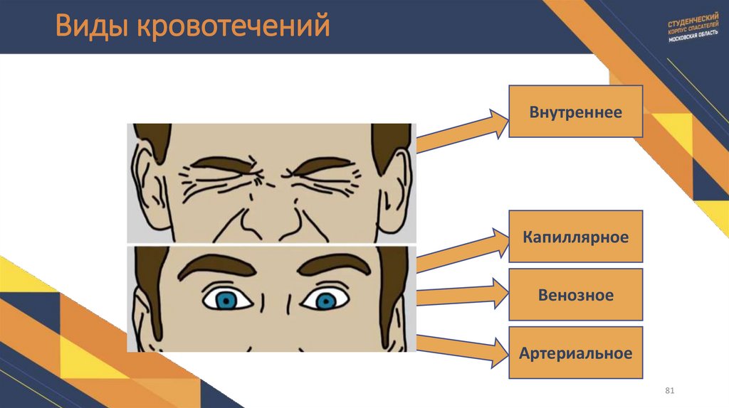Виды кровотечений