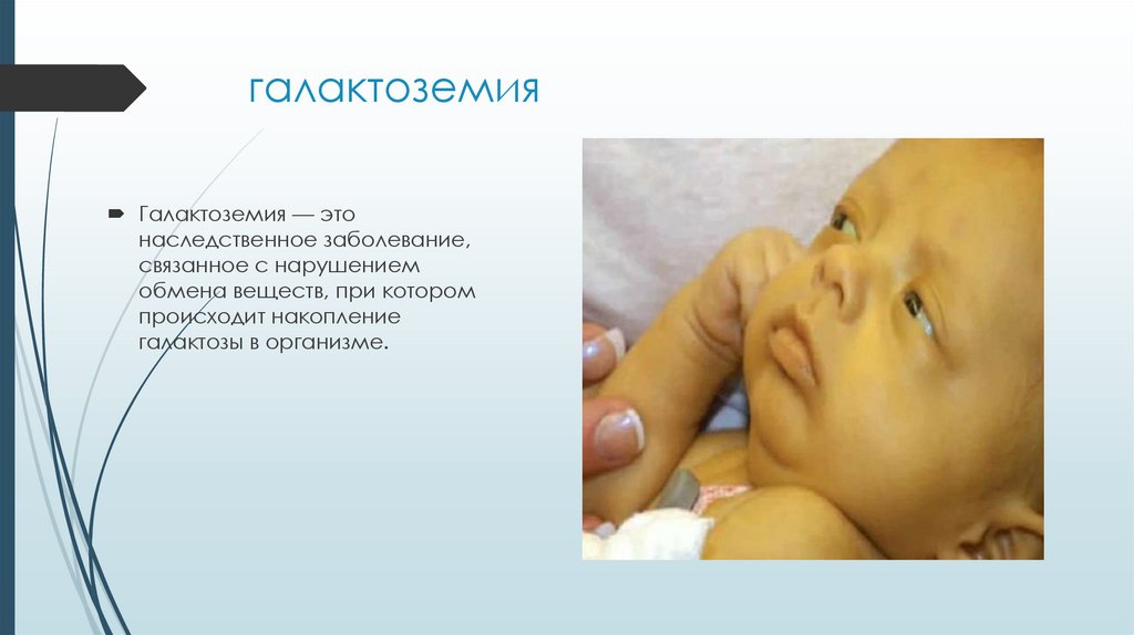 галактоземия