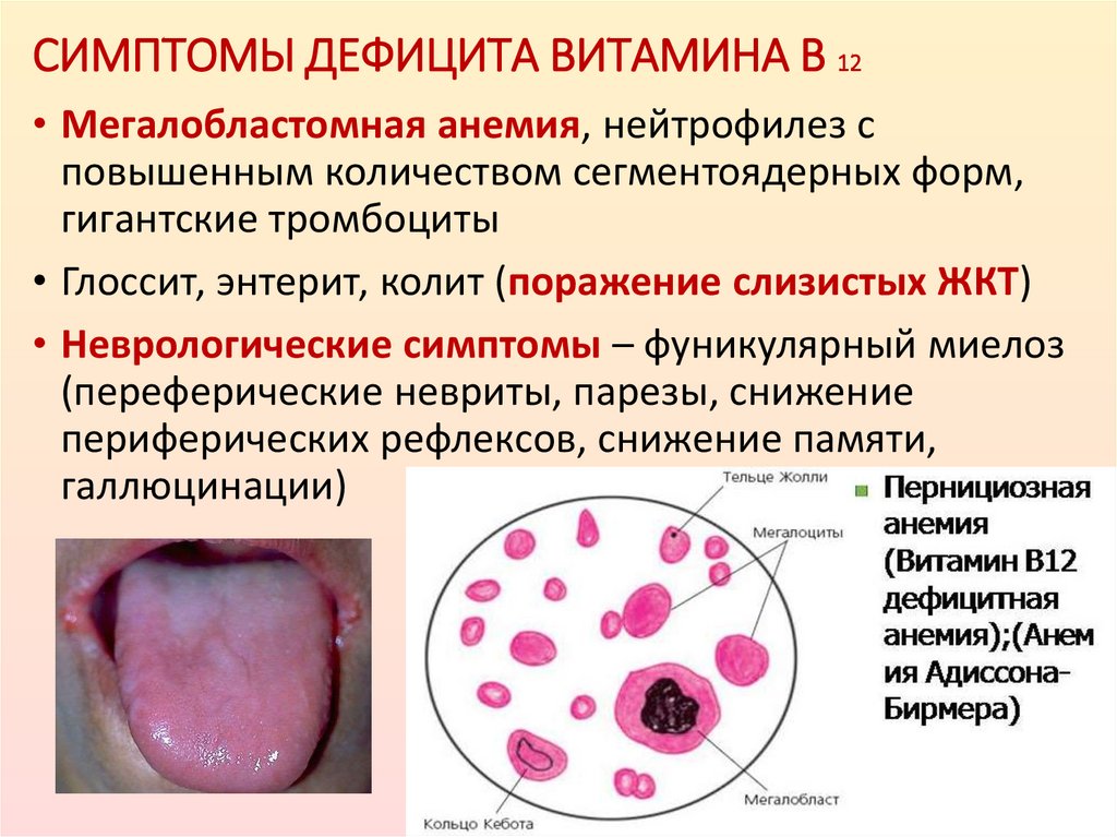 СИМПТОМЫ ДЕФИЦИТА ВИТАМИНА В 12