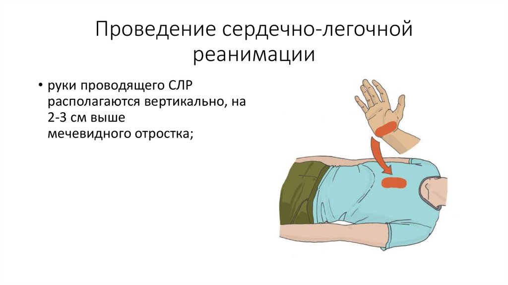 Проведение сердечно-легочной реанимации