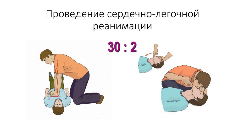 Проведение сердечно-легочной реанимации