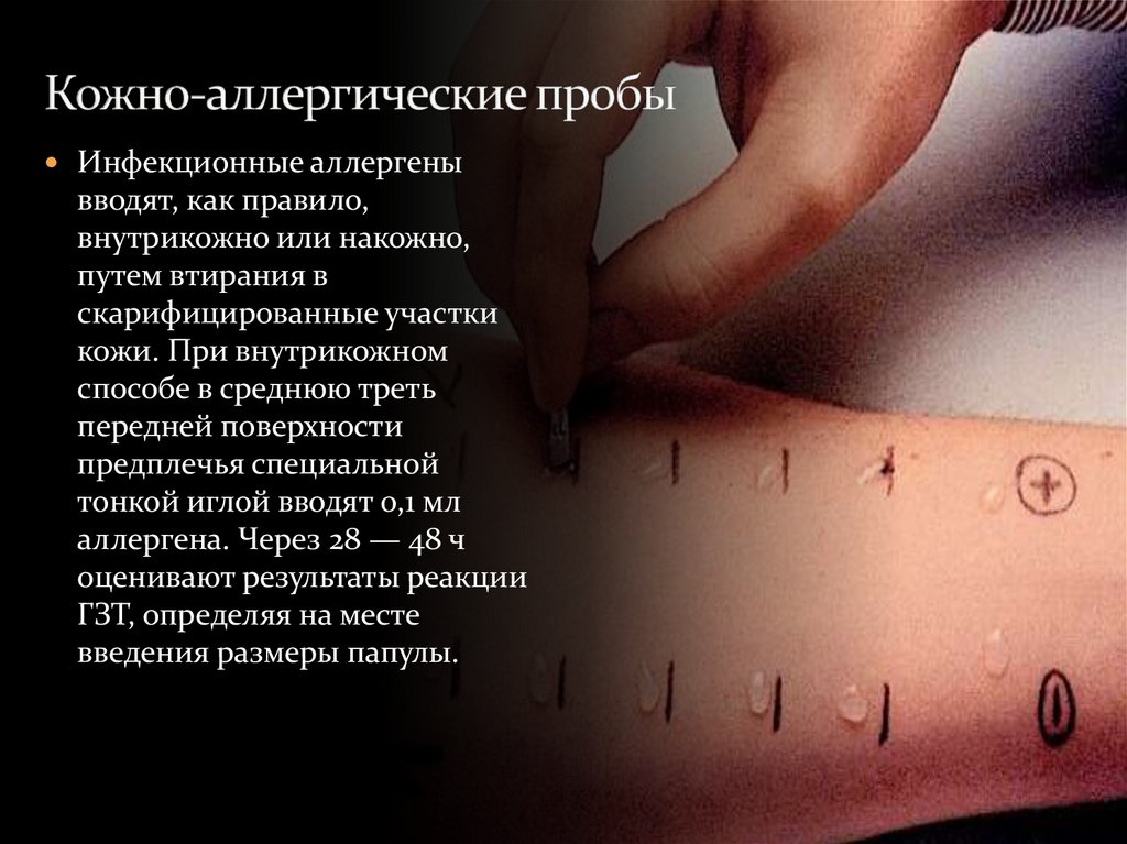 Кожно-аллергические пробы