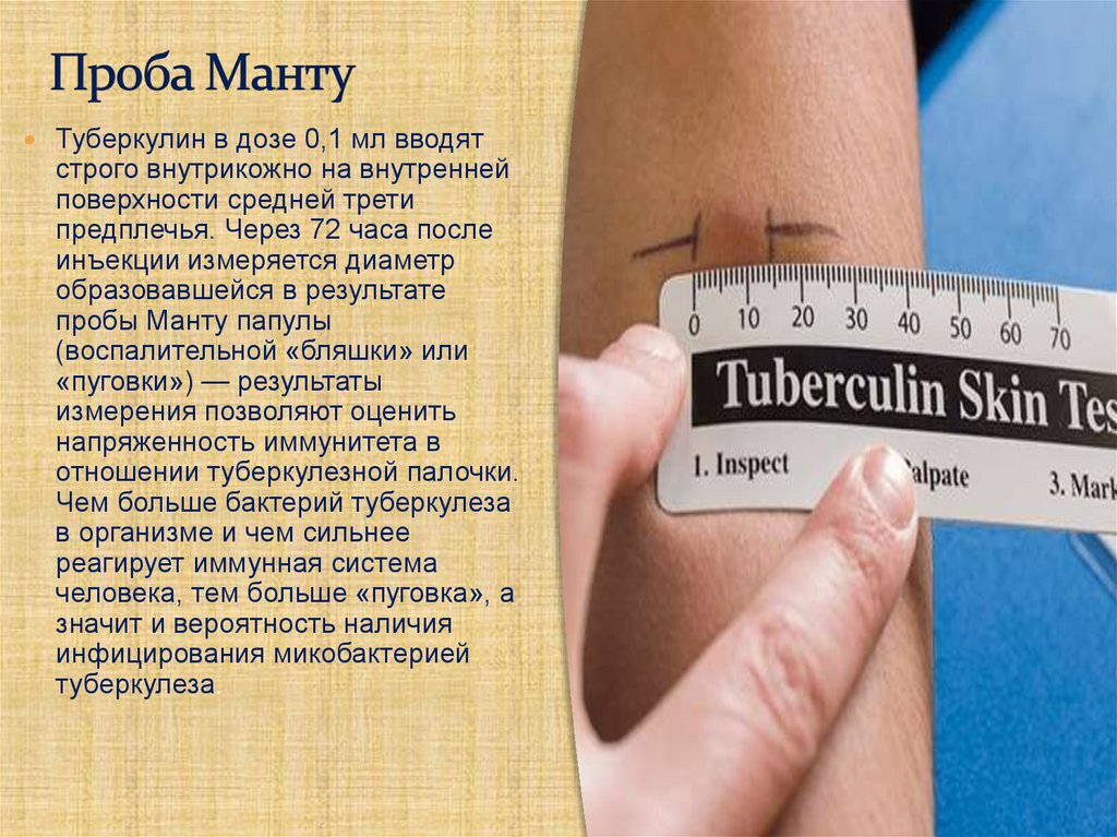 Проба Манту