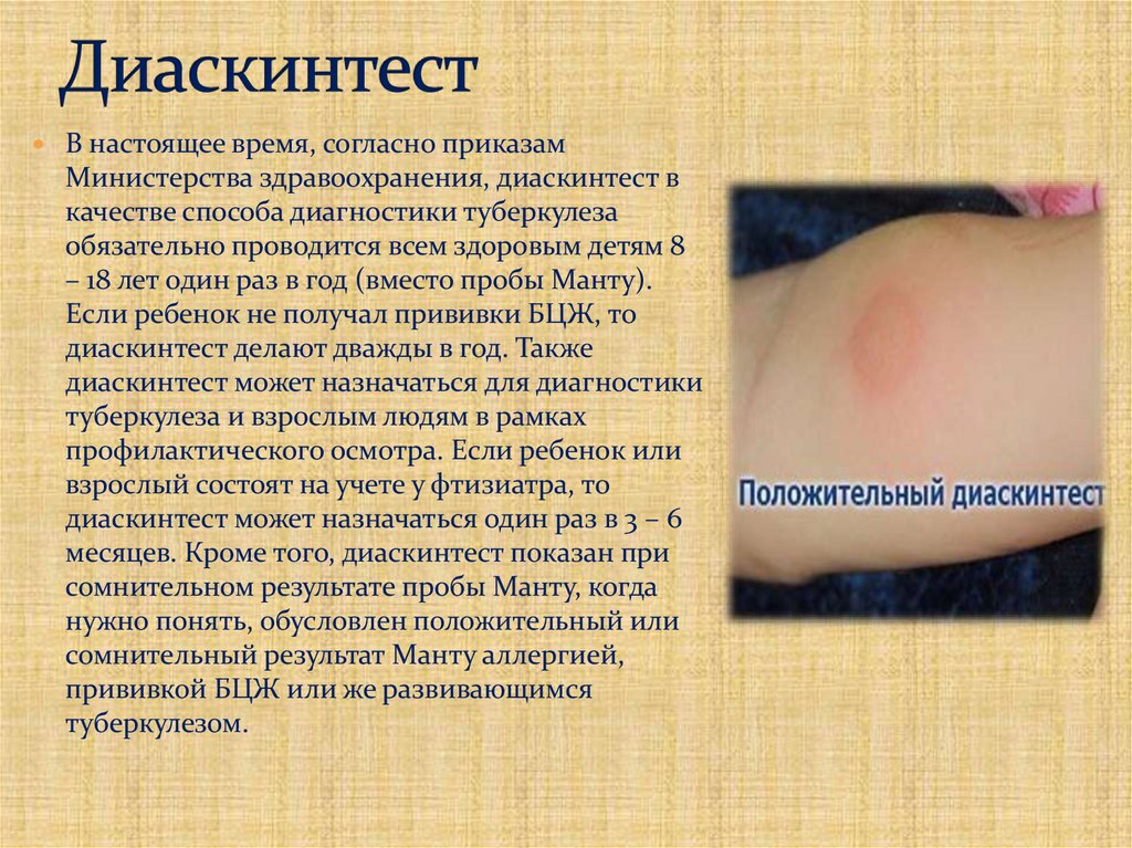 Диаскинтест