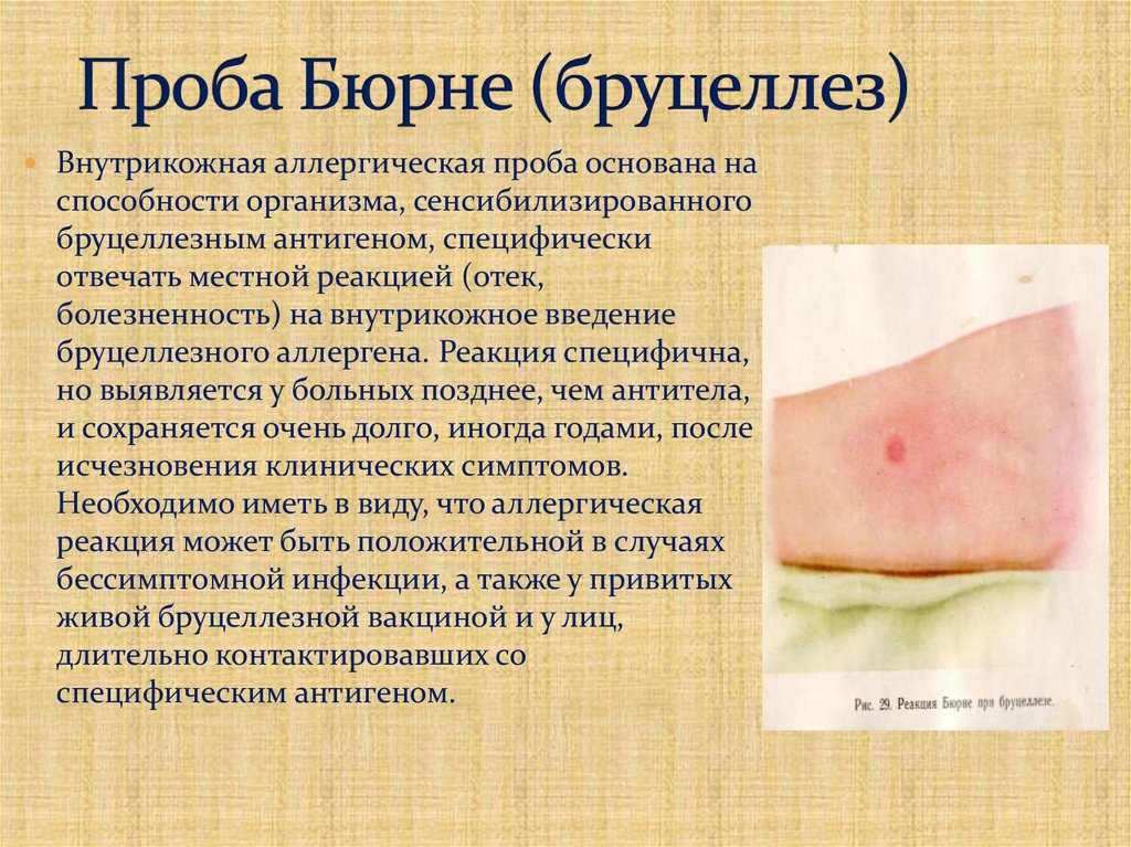 Проба Бюрне (бруцеллез)