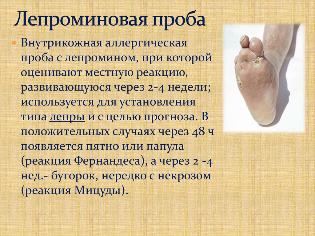 Лепроминовая проба