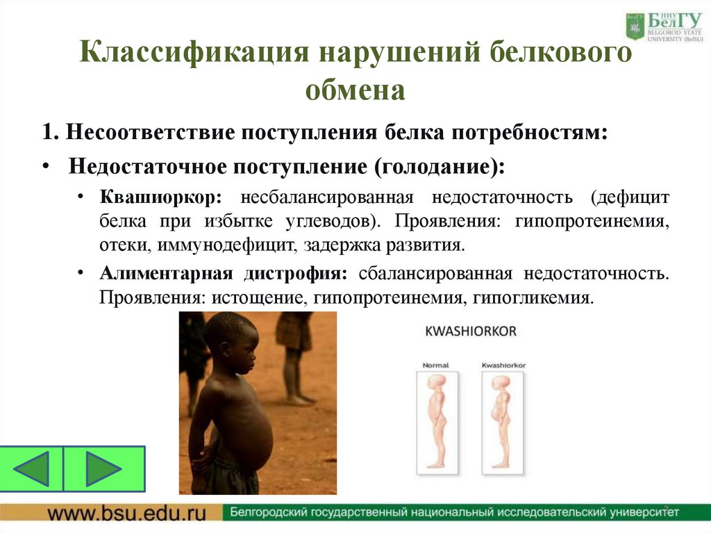 Классификация нарушений белкового обмена