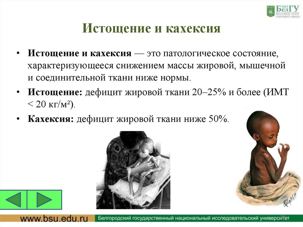 Истощение и кахексия