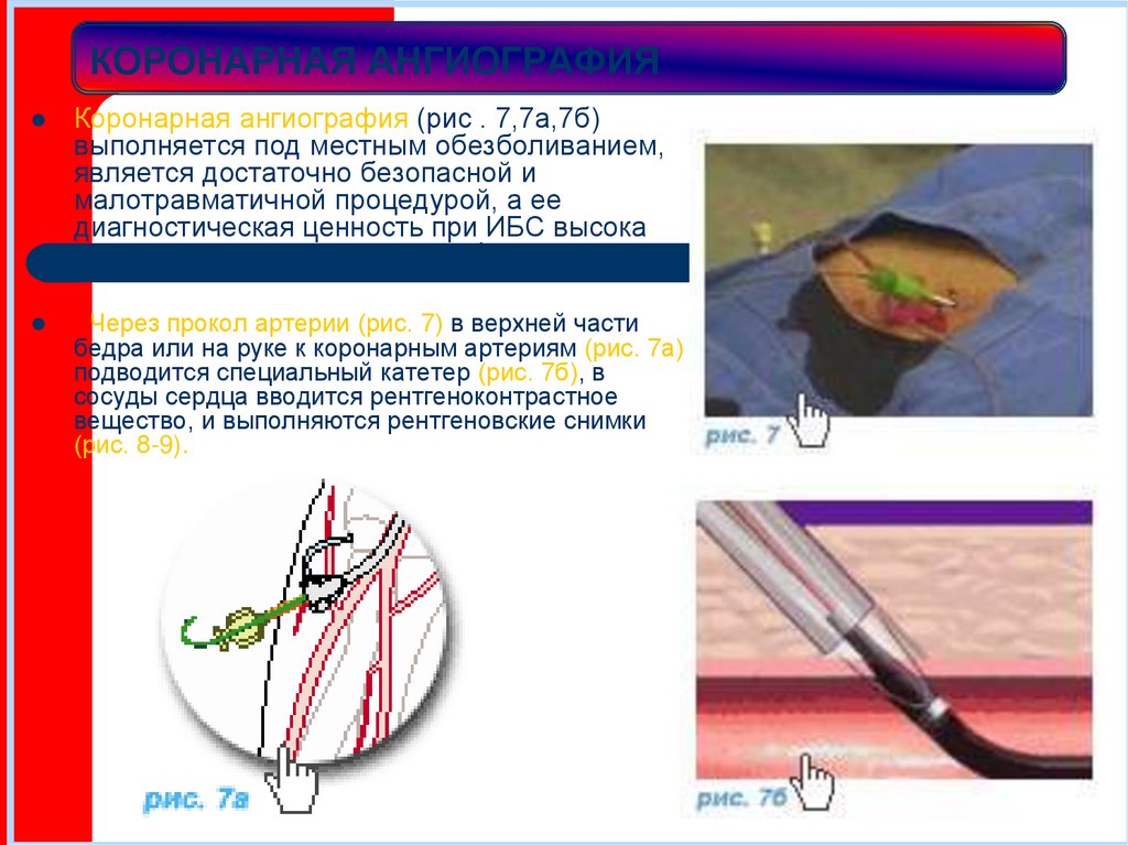 КОРОНАРНАЯ АНГИОГРАФИЯ