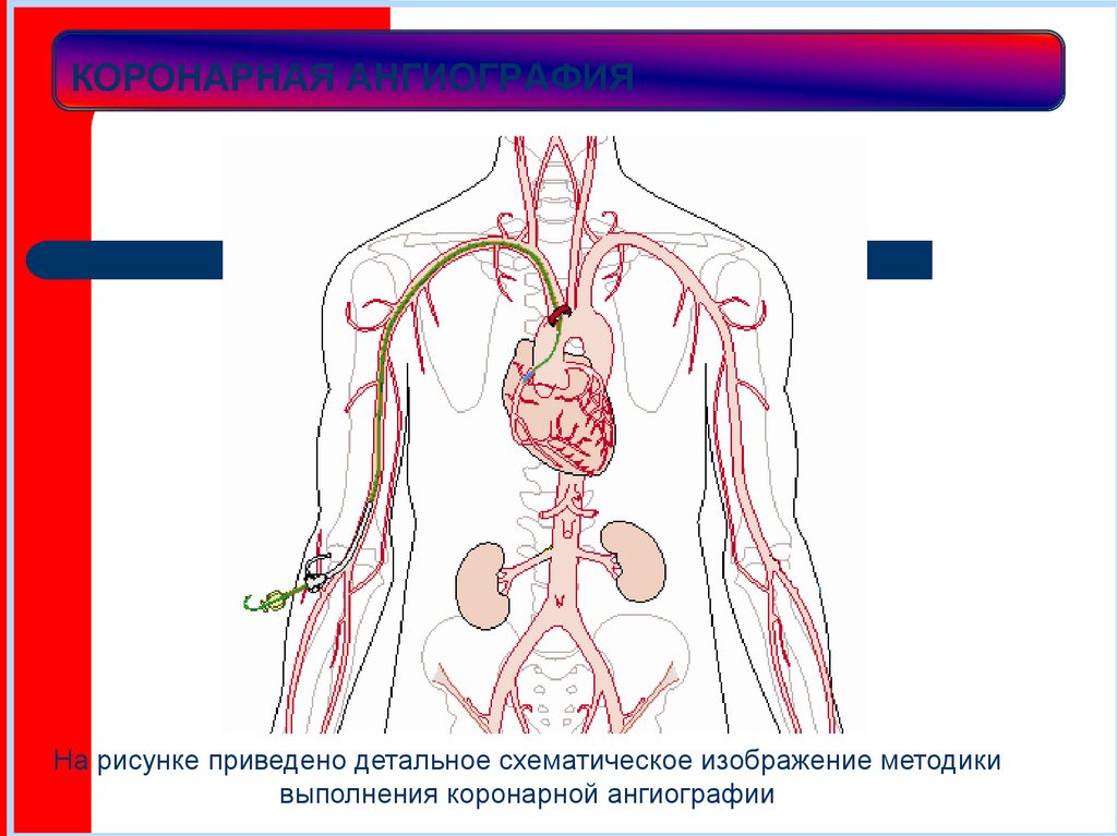 КОРОНАРНАЯ АНГИОГРАФИЯ