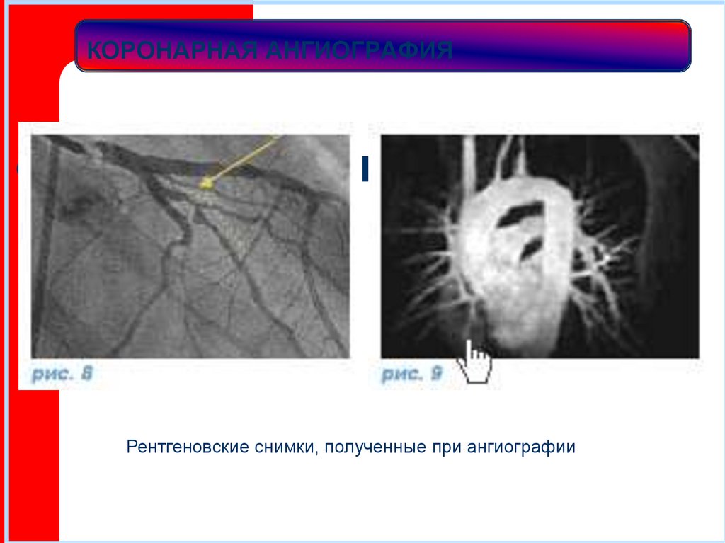 КОРОНАРНАЯ АНГИОГРАФИЯ