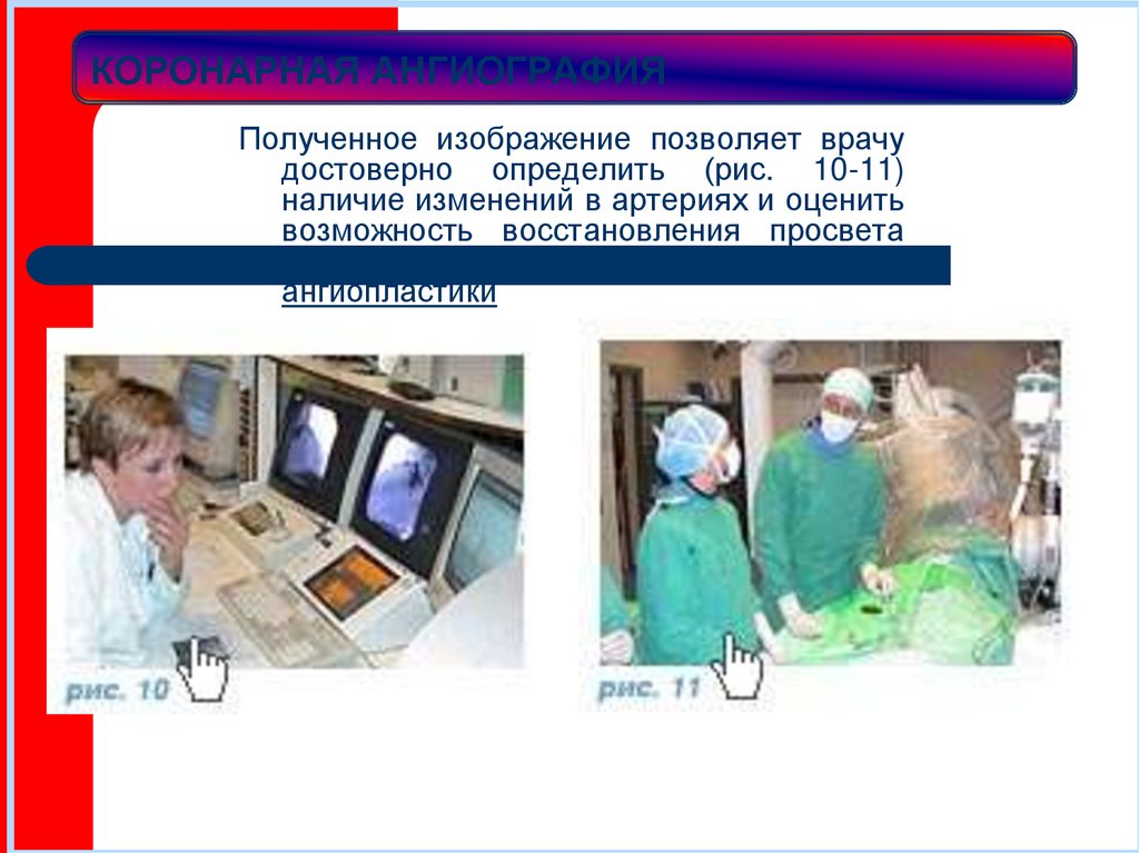 КОРОНАРНАЯ АНГИОГРАФИЯ