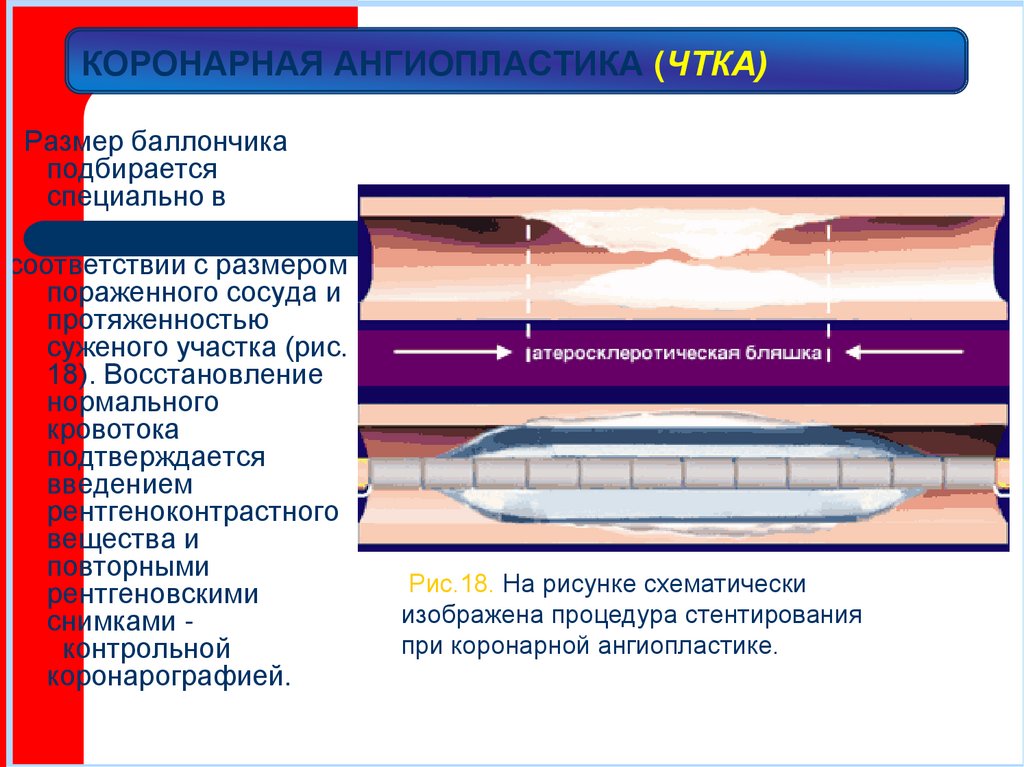 КОРОНАРНАЯ АНГИОПЛАСТИКА (ЧТКА)