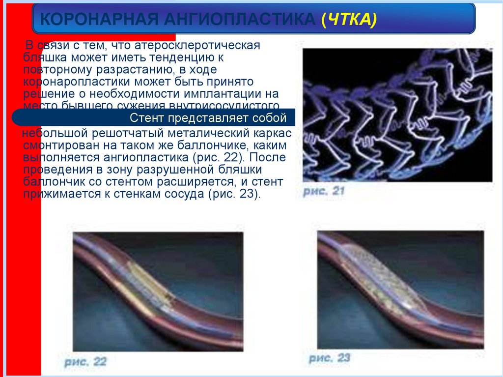 КОРОНАРНАЯ АНГИОПЛАСТИКА (ЧТКА)