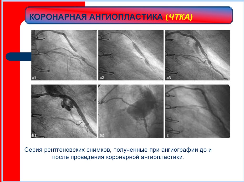 КОРОНАРНАЯ АНГИОПЛАСТИКА (ЧТКА)