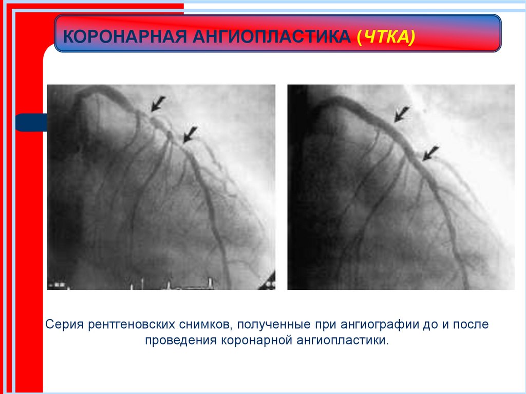 КОРОНАРНАЯ АНГИОПЛАСТИКА (ЧТКА)