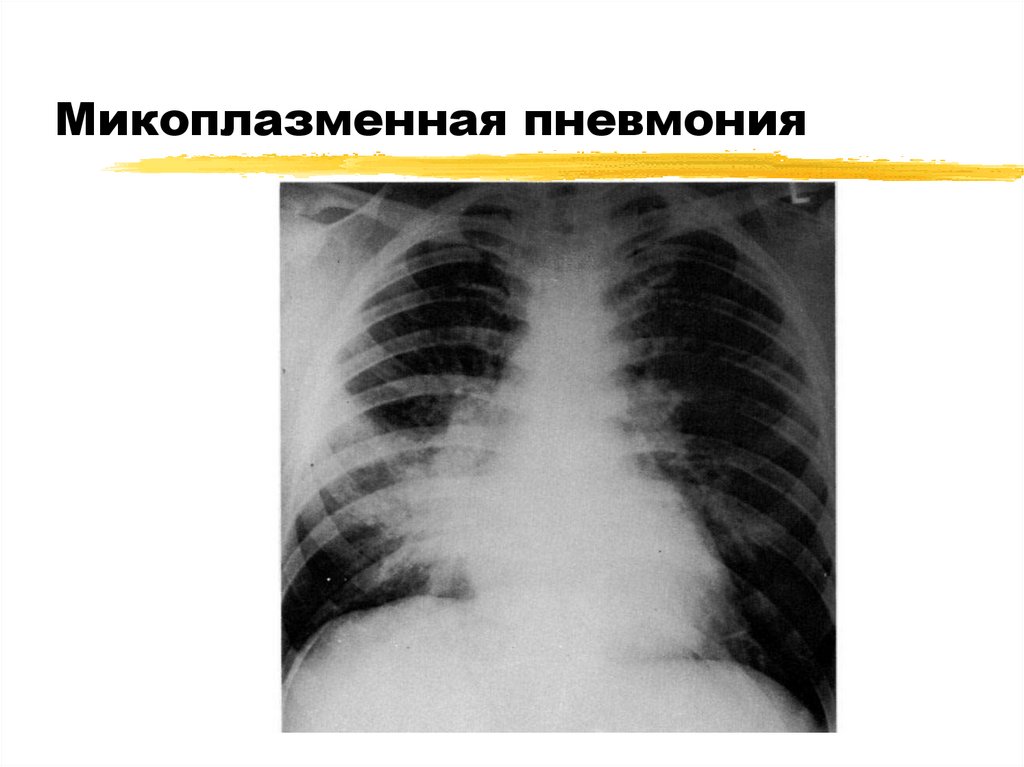 Микоплазменная пневмония