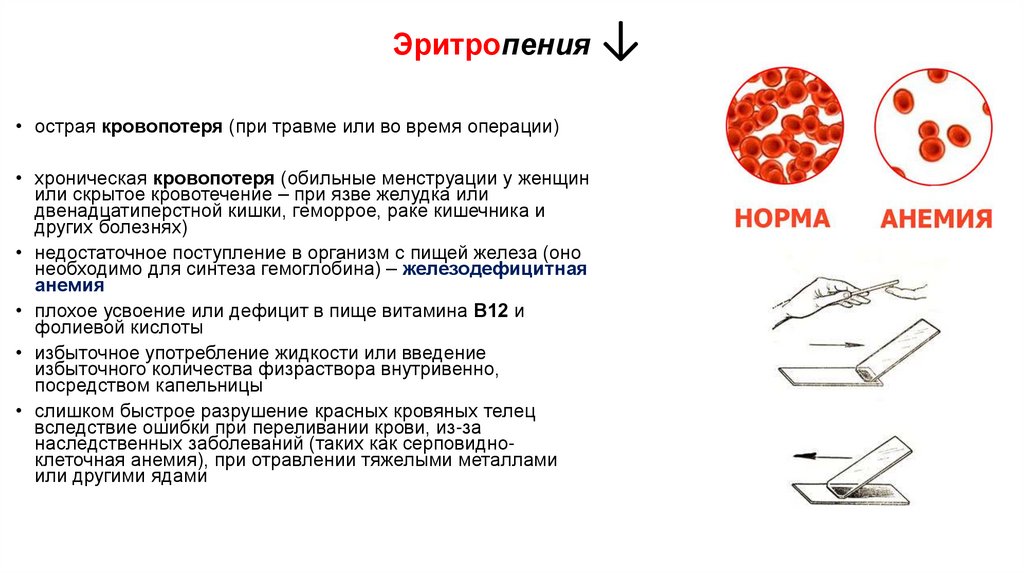 Эритропения ↓
