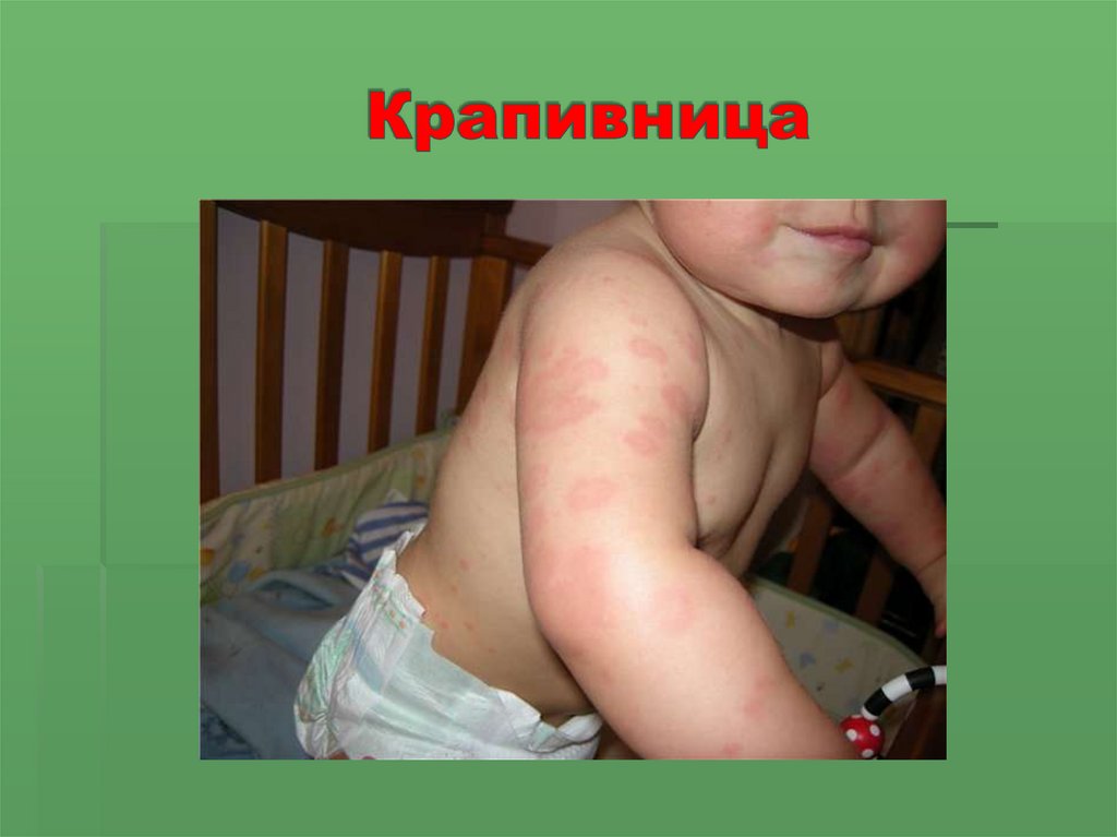 Крапивница