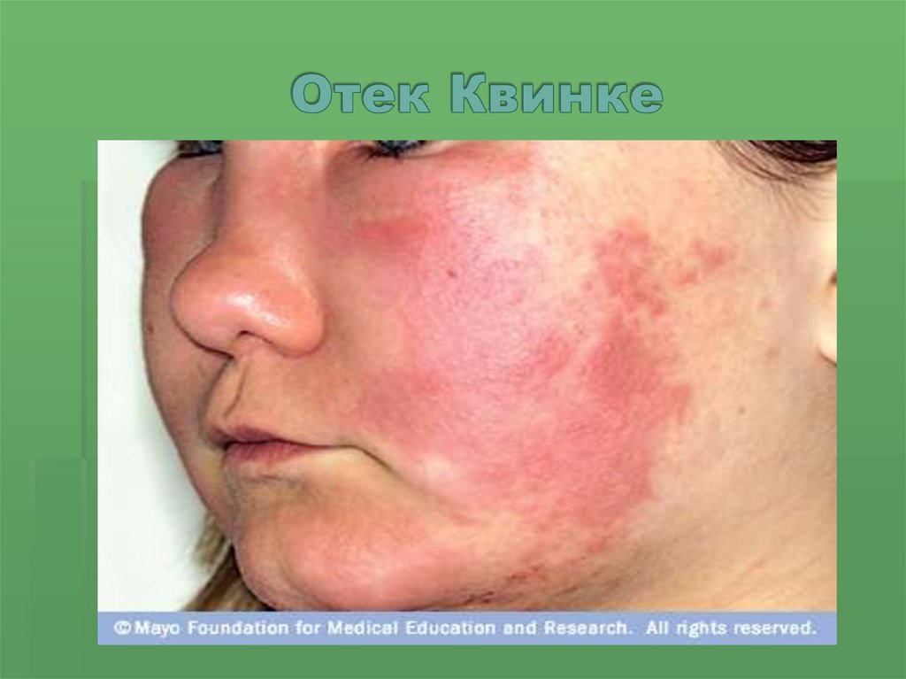 Отек Квинке