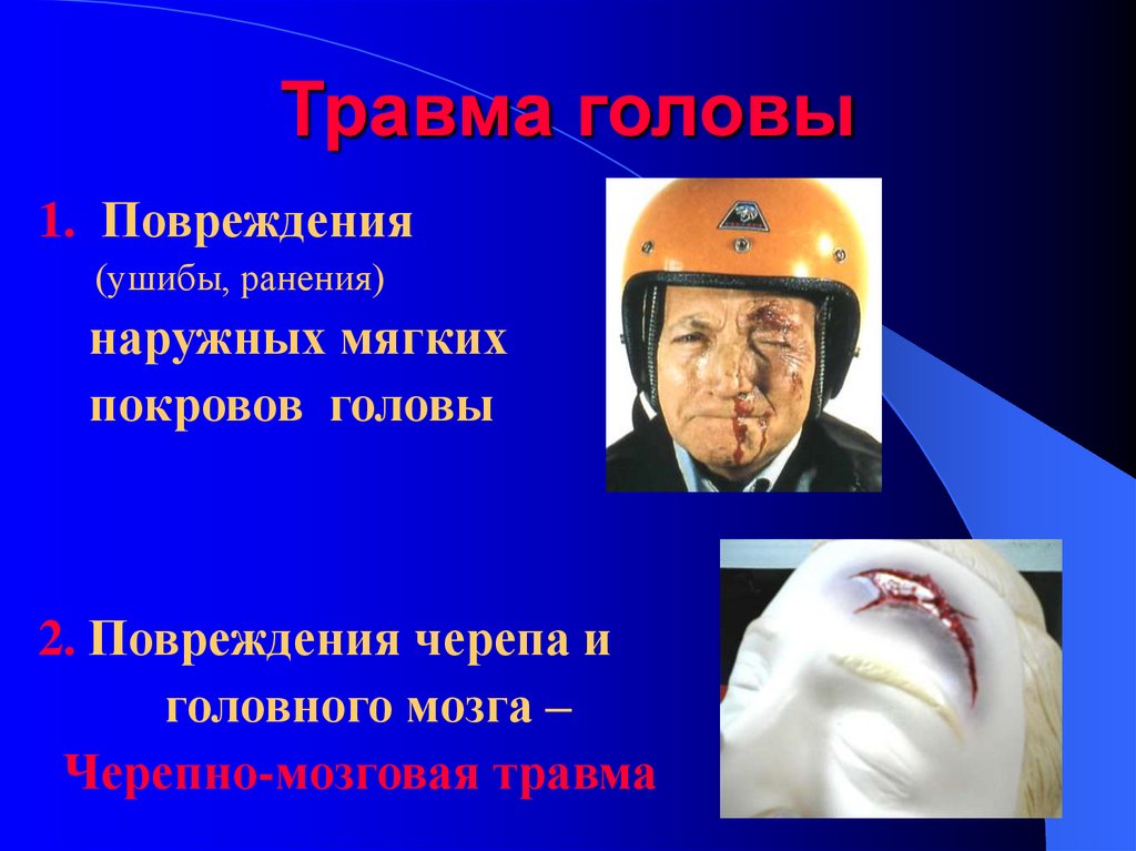 Травма головы