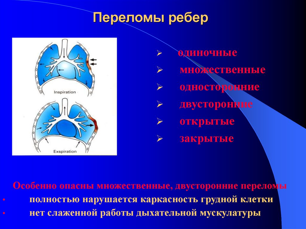 Переломы ребер