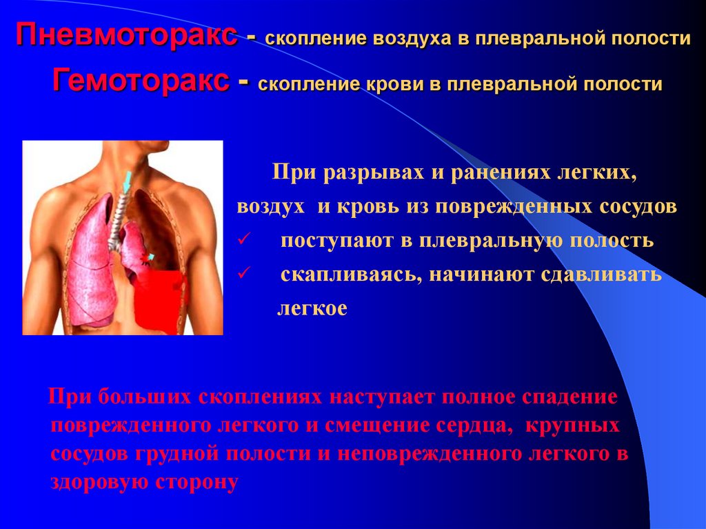 Пневмоторакс - скопление воздуха в плевральной полости Гемоторакс - скопление крови в плевральной полости