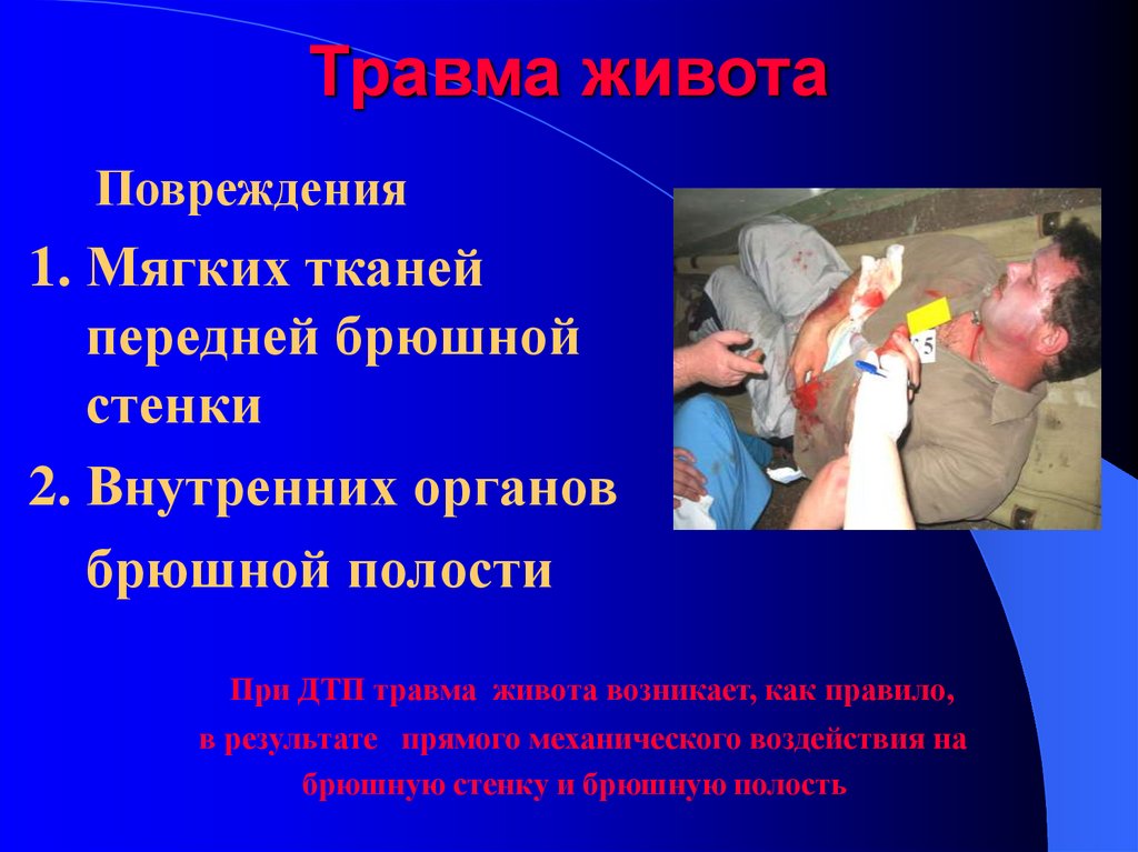 Травма живота