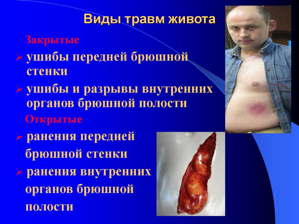 Виды травм живота