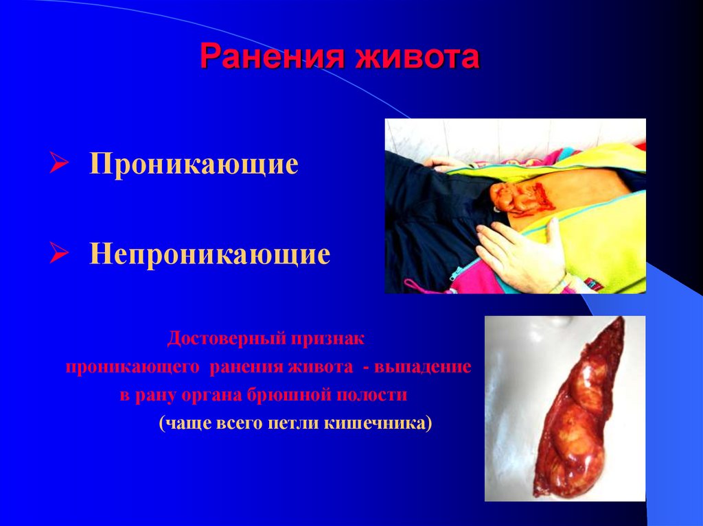 Ранения живота