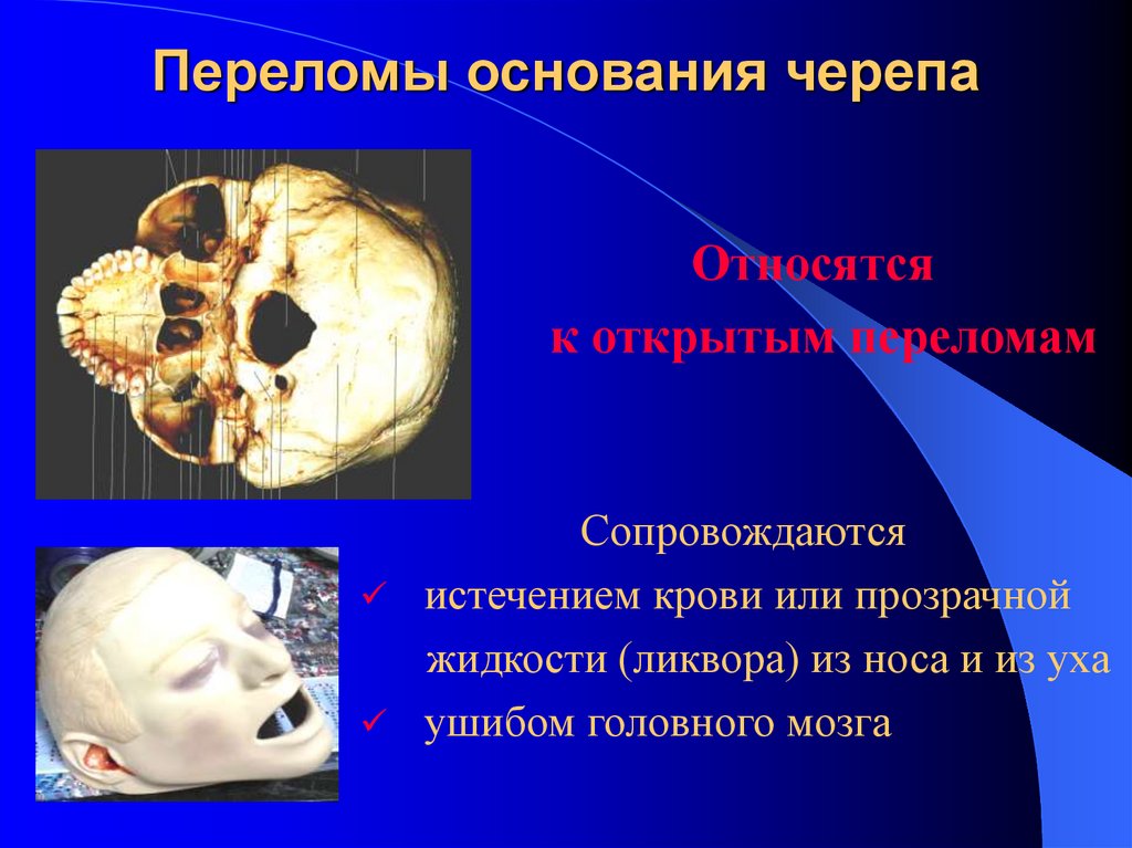 Переломы основания черепа