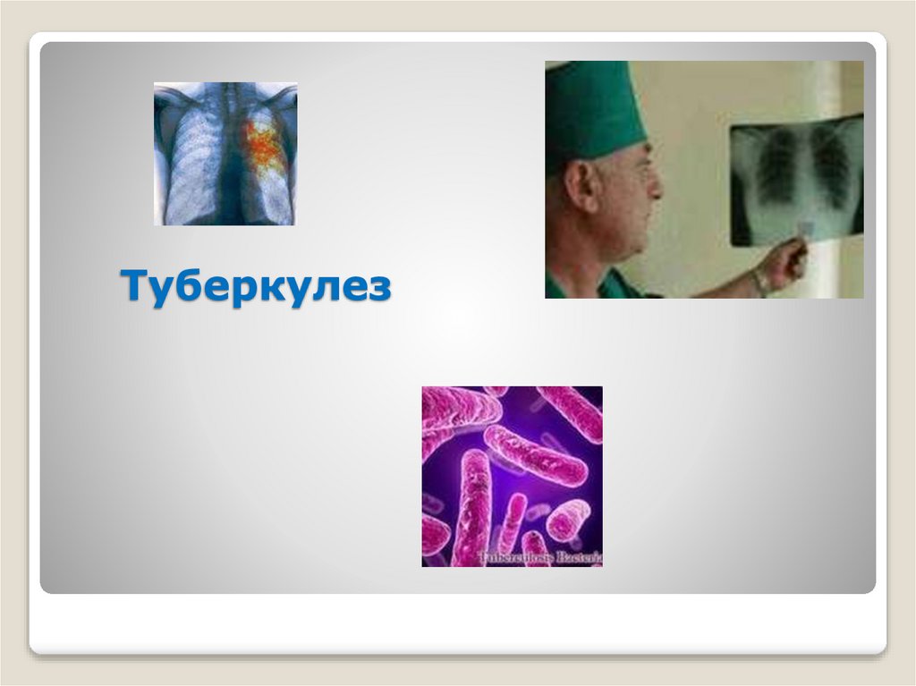 Туберкулез