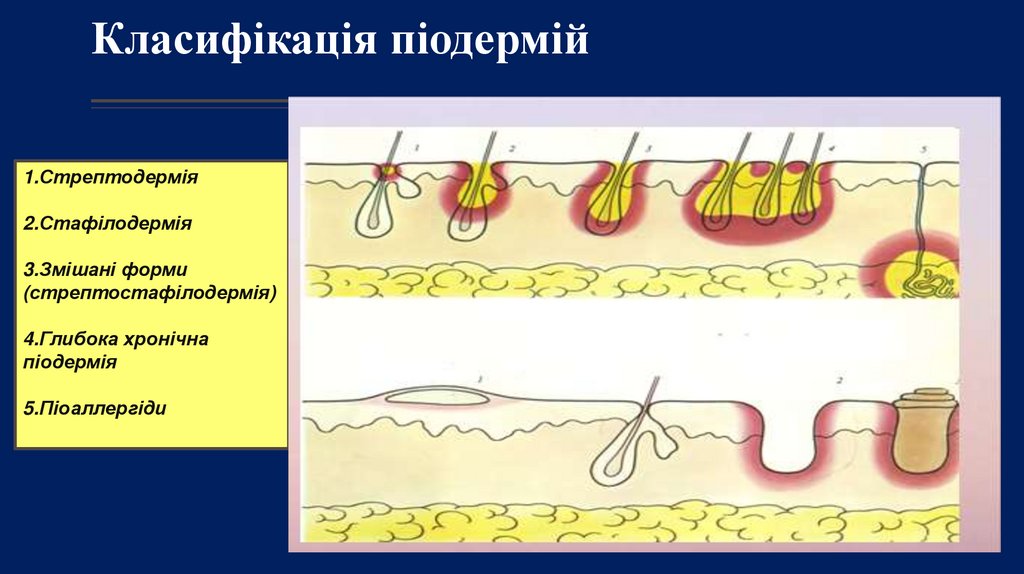 Класифікація піодермій