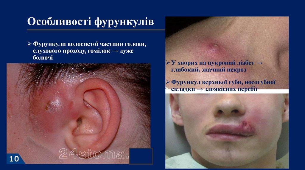 Особливості фурункулів