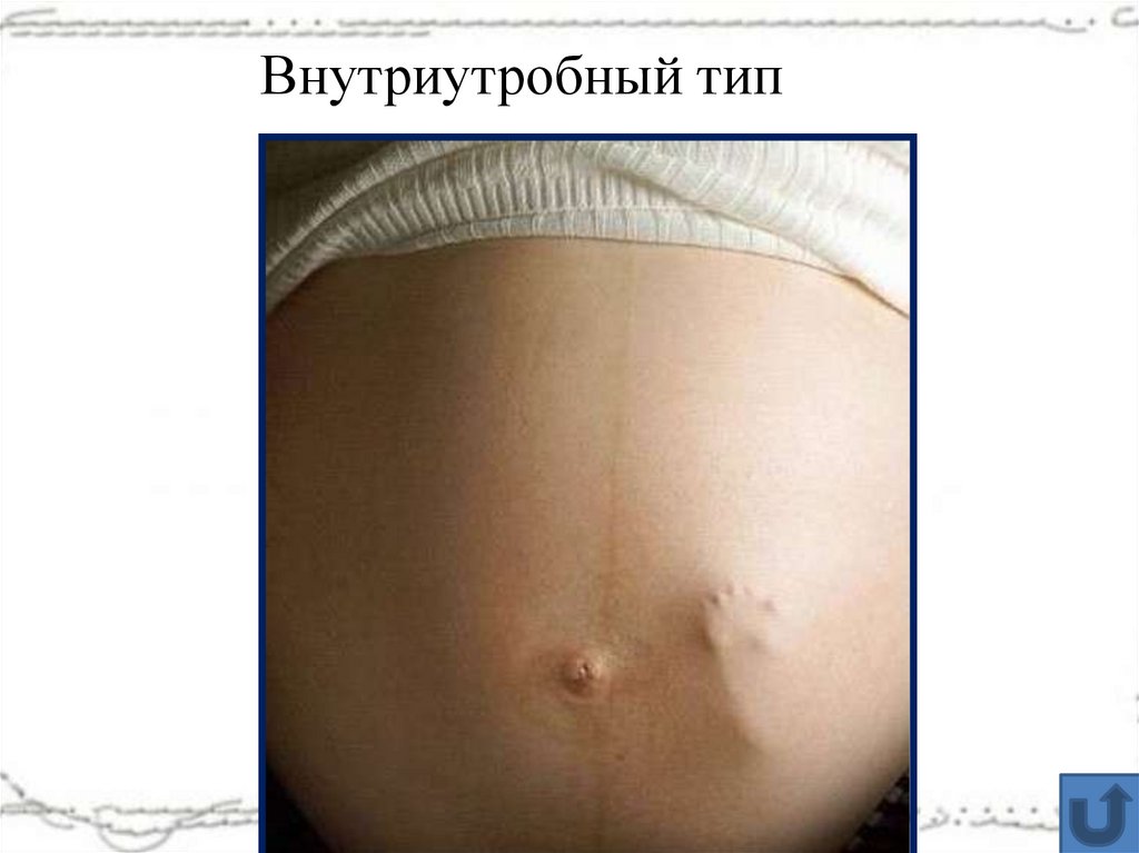 Внутриутробный тип