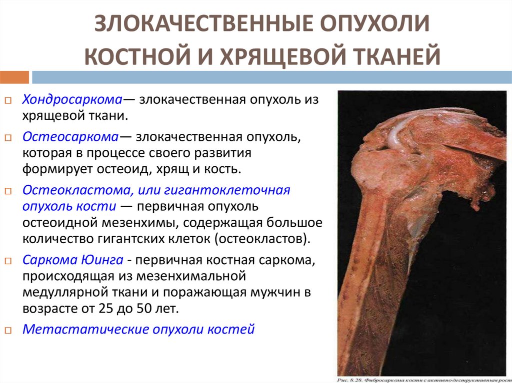 ЗЛОКАЧЕСТВЕННЫЕ ОПУХОЛИ КОСТНОЙ И ХРЯЩЕВОЙ ТКАНЕЙ