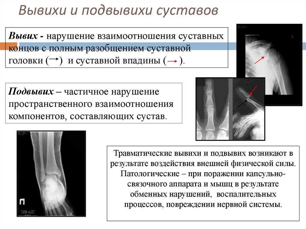 Вывихи и подвывихи суставов