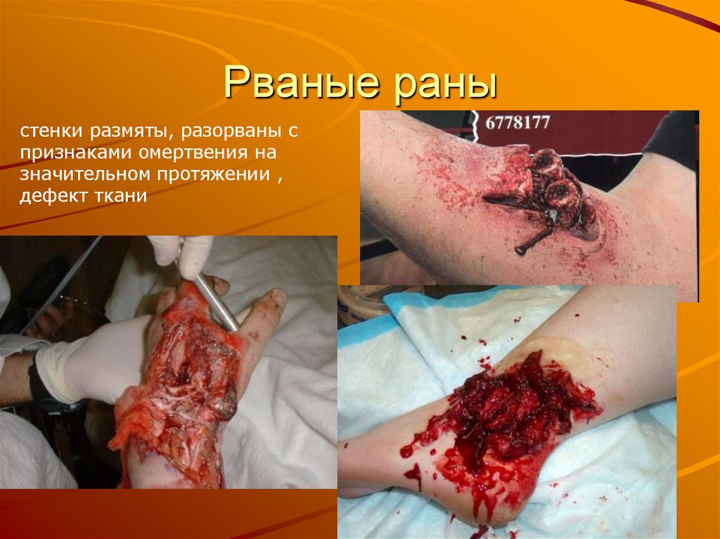 Рваные раны