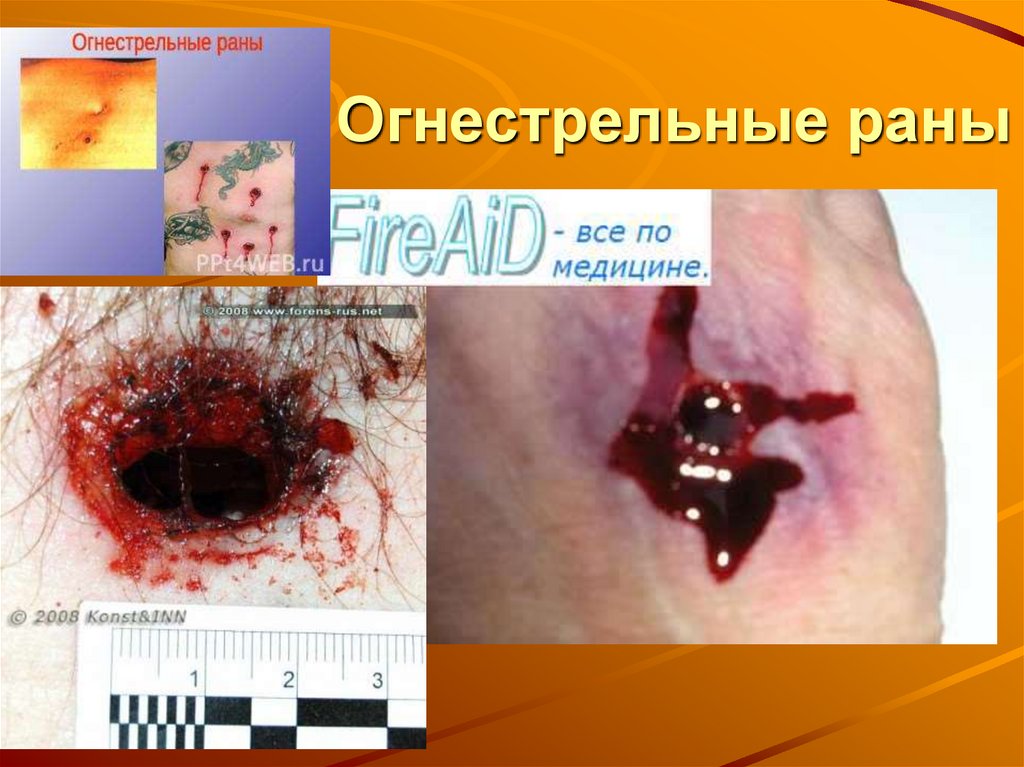 Огнестрельные раны