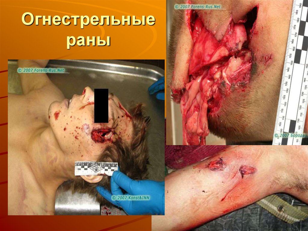 Огнестрельные раны