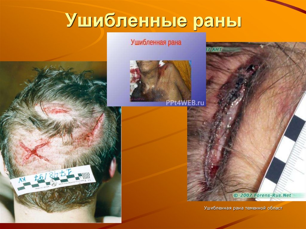 Ушибленные раны