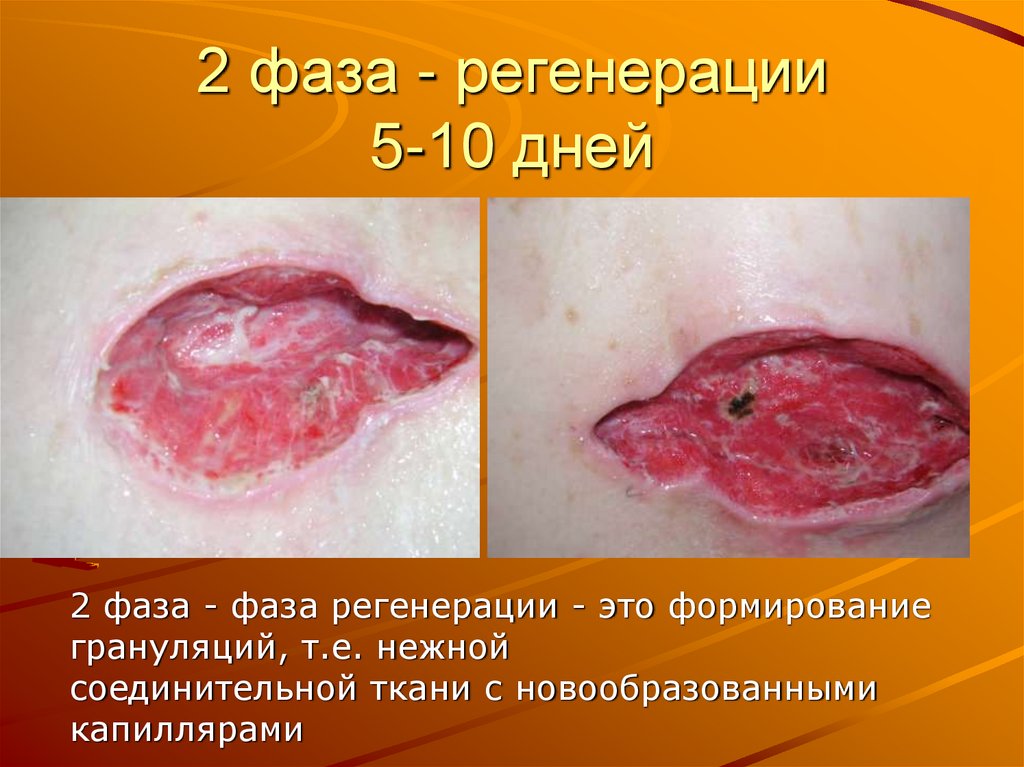 2 фаза - регенерации 5-10 дней