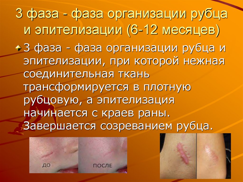 3 фаза - фаза организации рубца и эпителизации (6-12 месяцев)