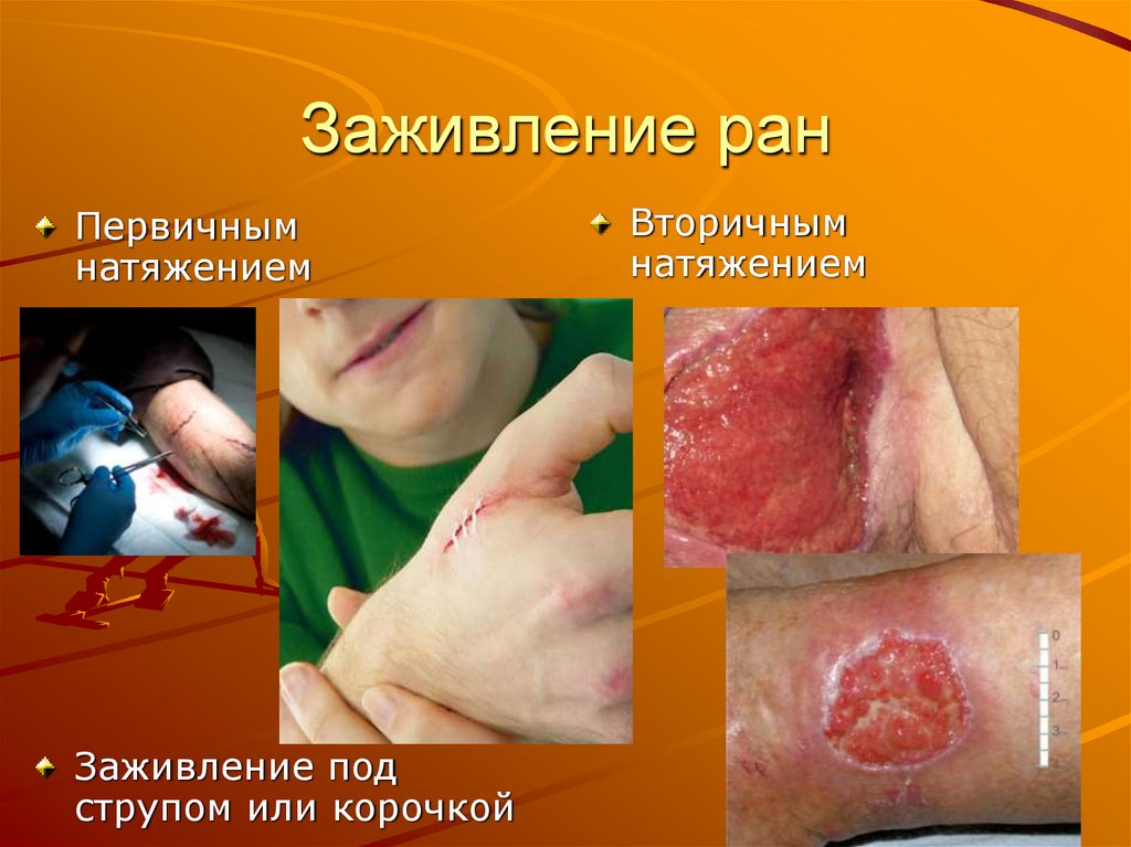 Заживление ран